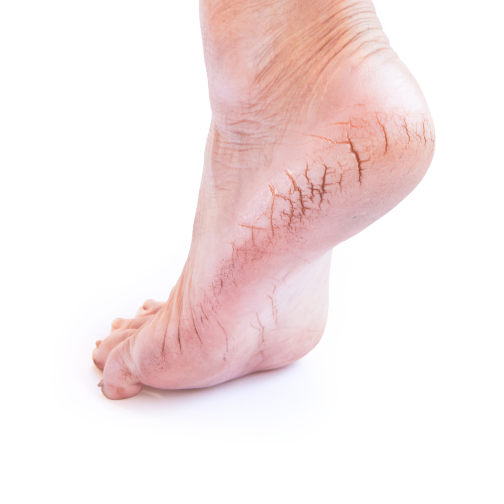 Rachaduras e Fissuras problemas nos pés que podem afetar não apenas os pés, mas também a postura e o equilíbrio do corpo, o que pode levar a dores e problemas em outras partes do corpo, como joelhos, quadris e costas. Ao praticar a podologia, você pode identificar e tratar precocemente condições.