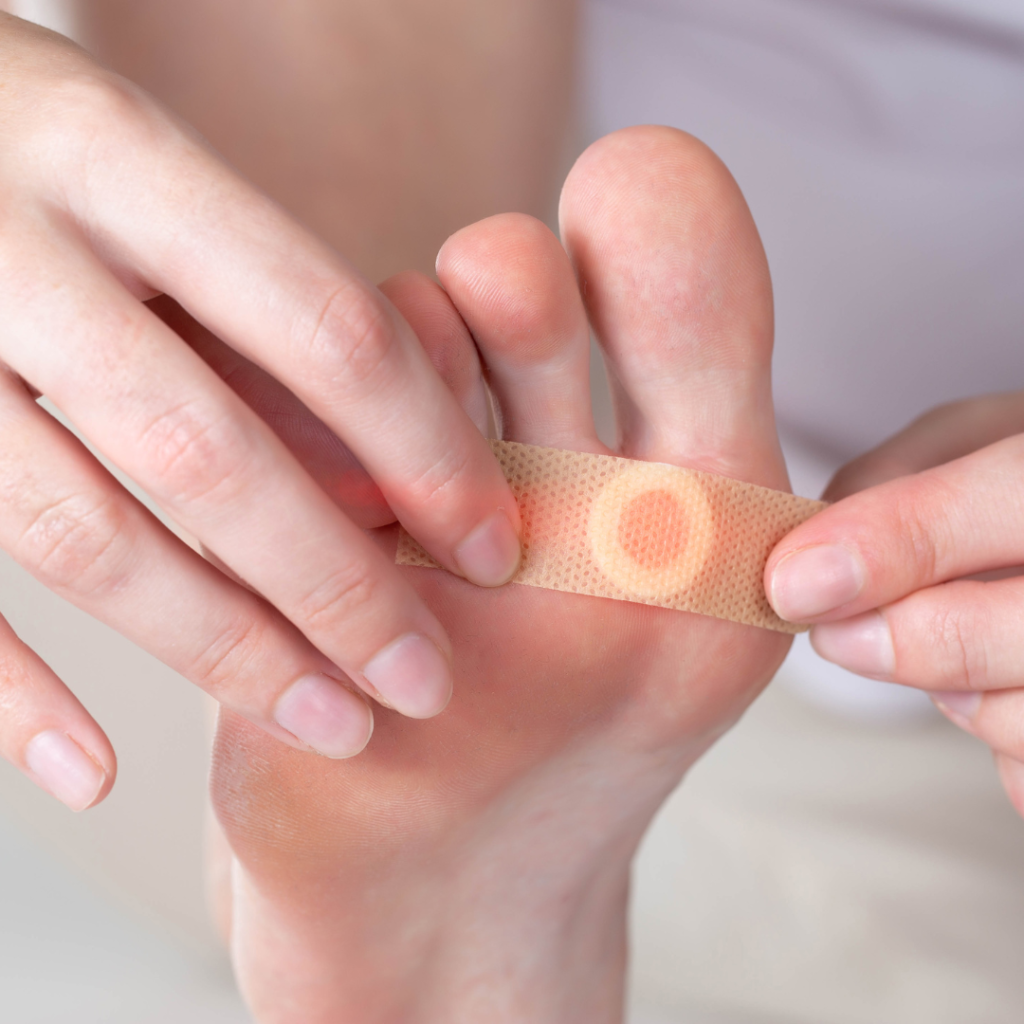 verruga plantar, também conhecida como verruga plantar, é uma lesão causada pelo vírus do papiloma humano (HPV) que se desenvolve na planta do pé. Ela pode ser desconfortável e dolorosa, especialmente ao caminhar.