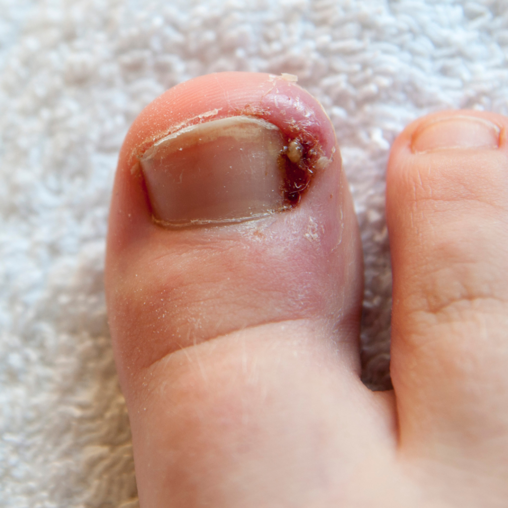 A onicocriptose, mais comumente conhecida como unha encravada, é uma condição  em que a borda lateral ou a extremidade de uma unha cresce para dentro da pele circundante do dedo, causando desconforto, dor, inflamação e, em casos graves, infecção.