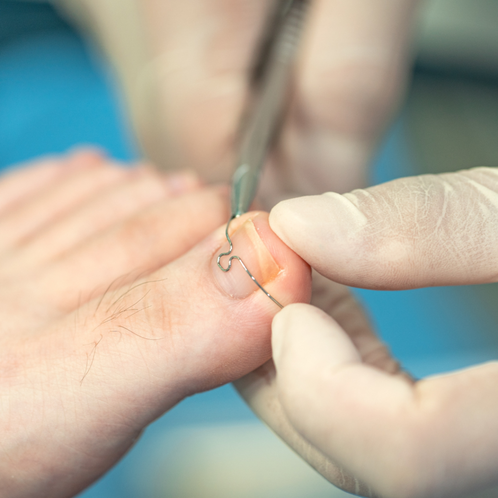 A órteses para correção das unhas são dispositivos utilizados por podólogos e profissionais de saúde para ajudar a tratar e corrigir problemas nas unhas, como unhas encravadas ou deformidades.​