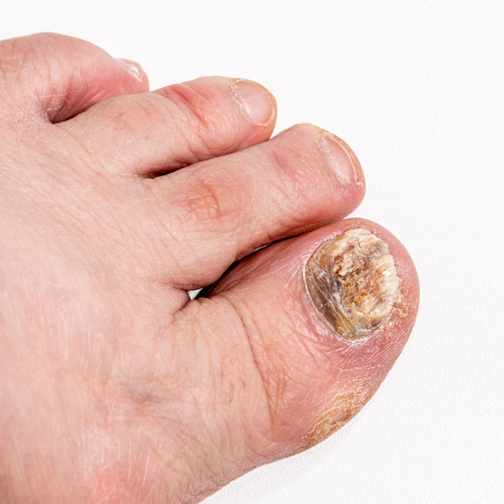 Fungos nas unhas, conhecidos como onicomicose ou micose nas unhas, são infecções fúngicas que afetam as unhas dos dedos das mãos ou dos pés.